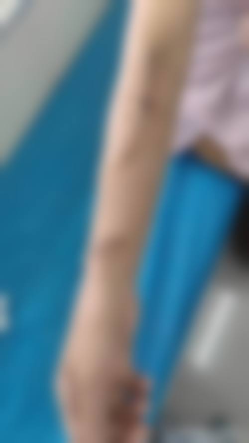 分疤治疗更精细