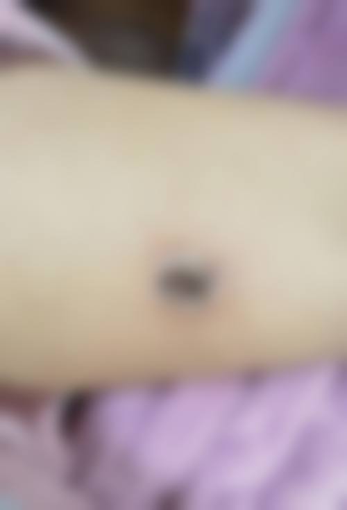 华美疤痕修复怎么样啊？王洪宇等医生领衔，分疤治疗，患者口碑满意度高！ 