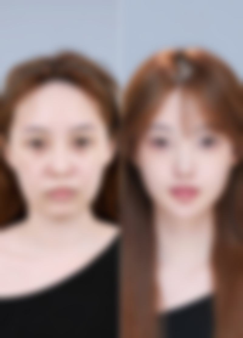 割双眼皮要多久回复？埋线1-2周伤口愈合，全切1-3个月完全恢复，护理好提速