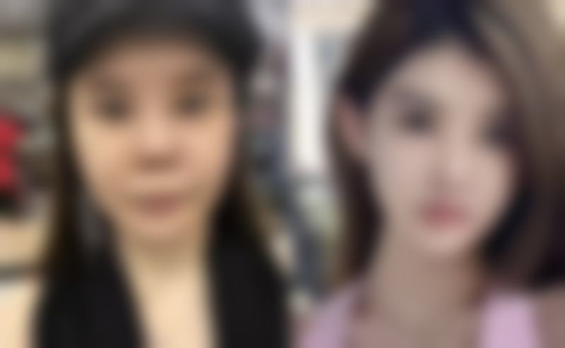 选对医院医生,心脏不好也能安心祛眼袋