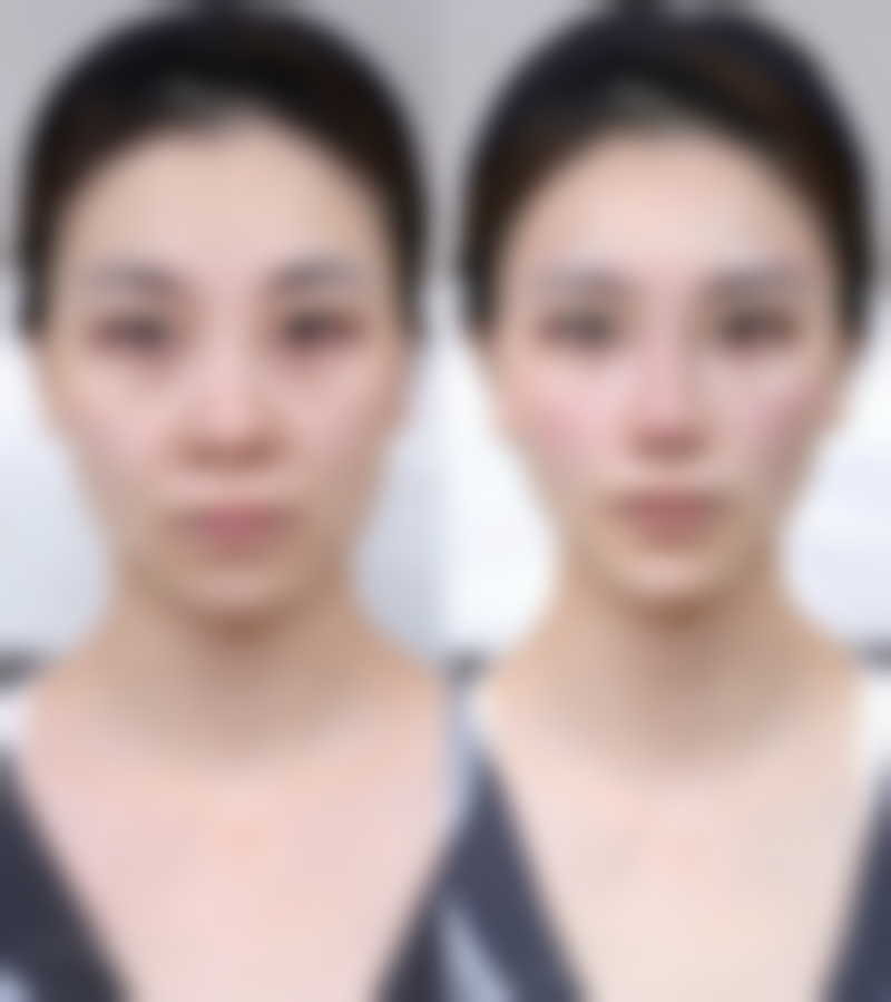 双眼皮手术的风险与术后护理