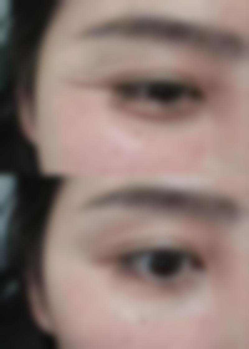 佛山市第一人民医院美容科收费高吗？双眼皮3000 - 10000元、隆鼻3000 - 20000元！ 