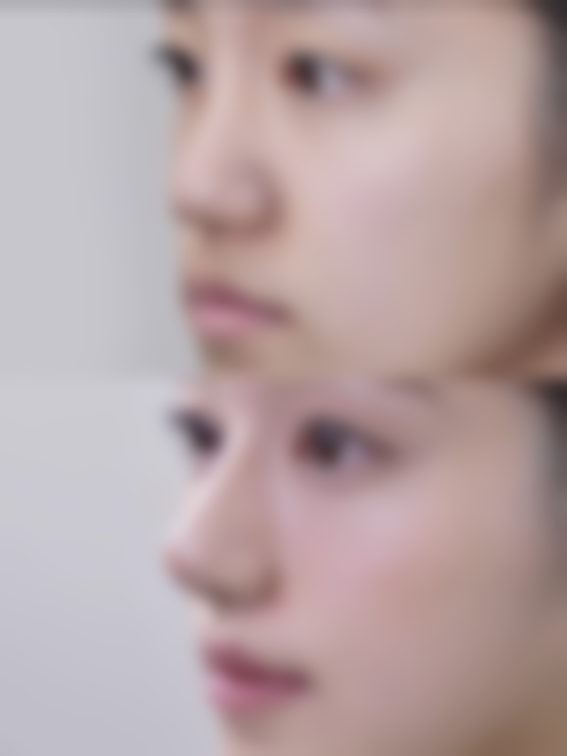 心脏不好祛眼袋,非手术方法也有妙招