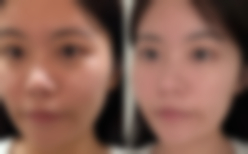 双眼皮手术的价格参考