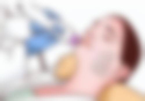 眶隔释放去眼袋术：去除眼袋，同时填充泪沟一步搞定