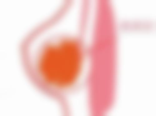 丰胸的正确选择