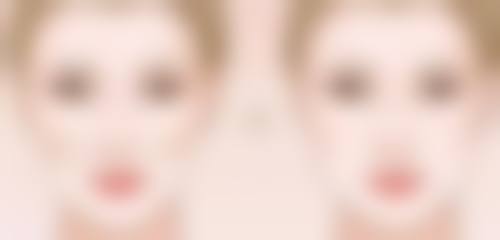 放射治疗：抑制疤痕增生的辅助手段