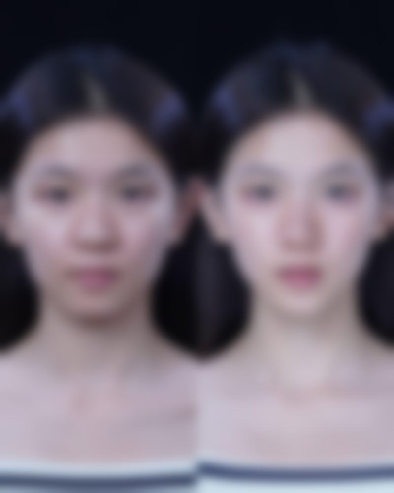 其他因素对眼皮形态的影响