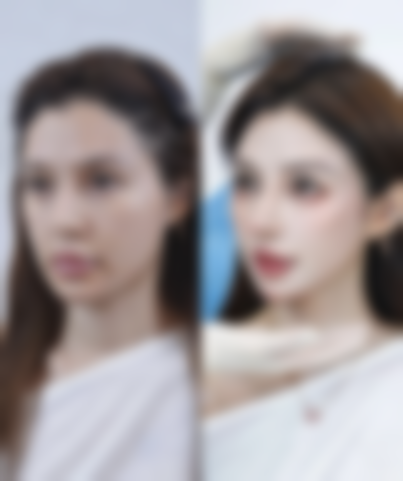 脸上的疤痕疙瘩怎么治疗？个性化方案+LCR技术，真人案例验证成效显著