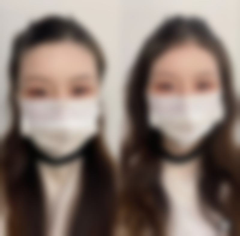 术前术后注意事项：保护去眼袋成效的关键步骤