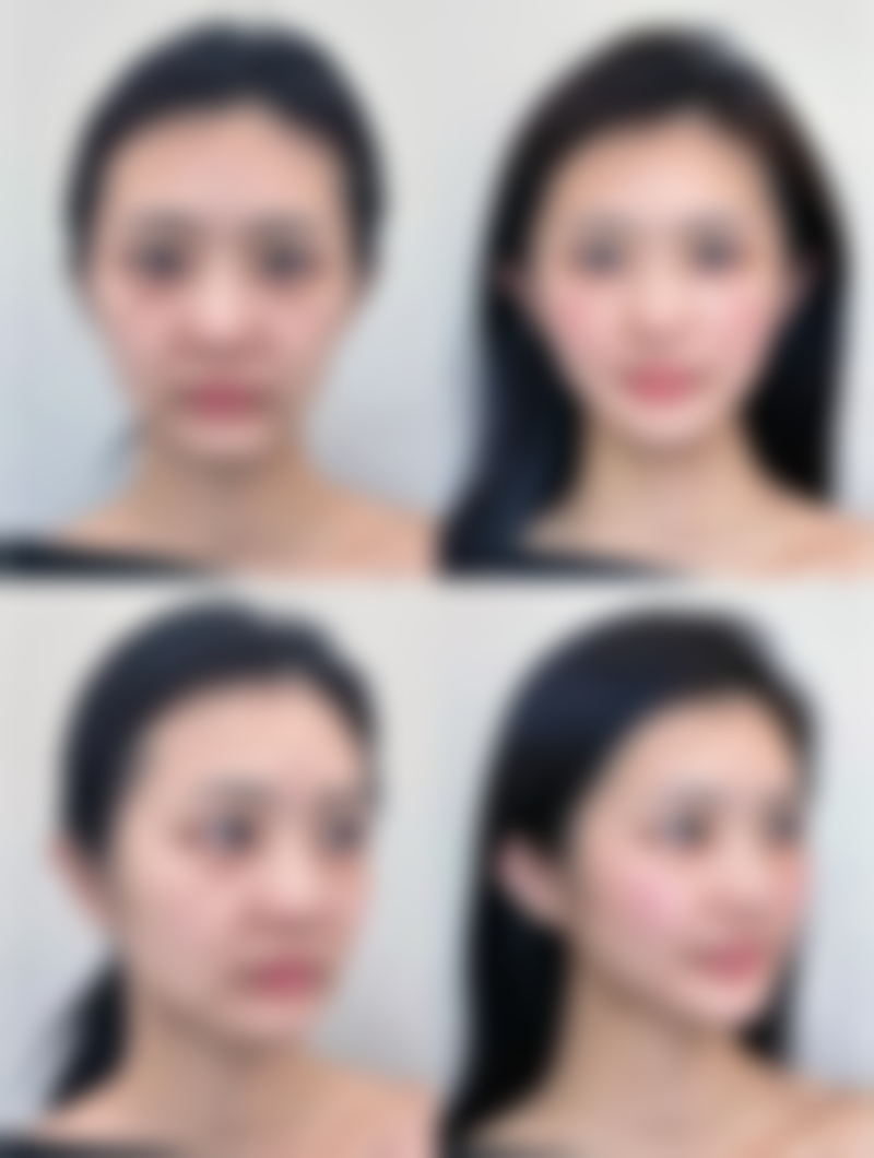 抽烟引发的修复问题:疤痕增生与形态不对称