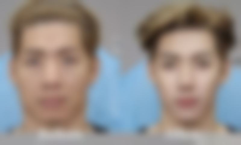 先天发育异常:少数人天生眼皮褶皱多