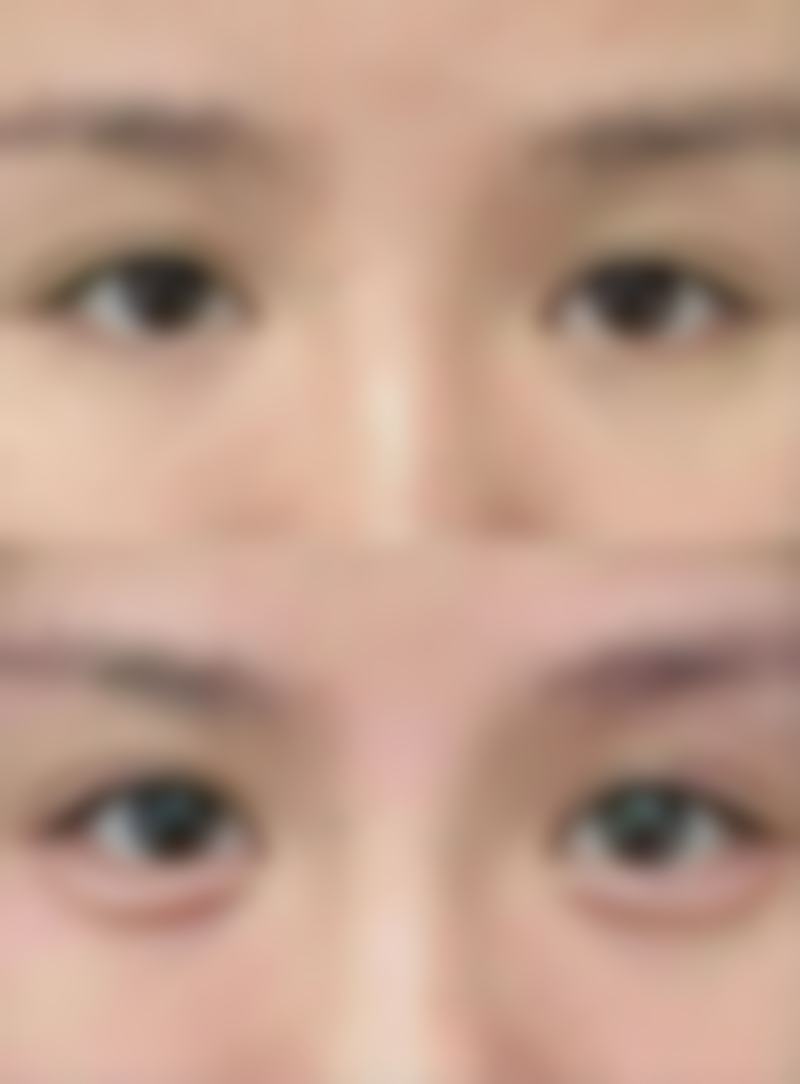 手术问题:双眼皮手术失败成三眼皮