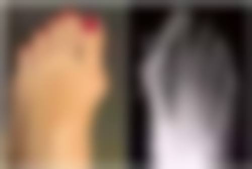 玻璃酸去眼袋的安心性与风险