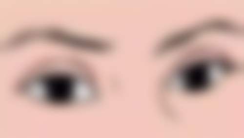 成年后去眼袋：选择与注意事项