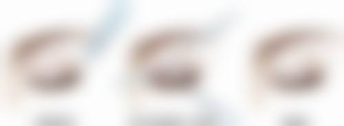 大腿环吸抽脂不反弹的成功实例分享