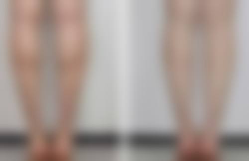 专精医生助力:如何挑选成就理想双眼皮的医生