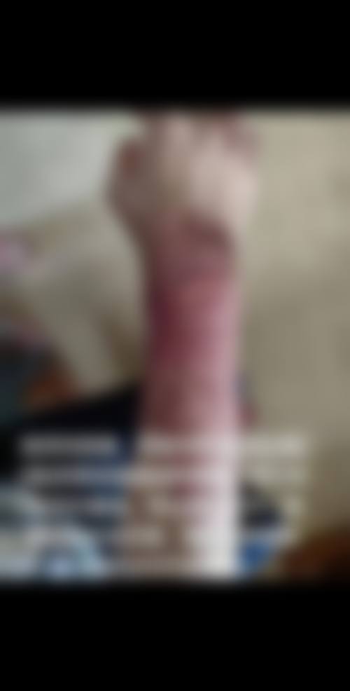 武晓莉医生擅长的疤痕修复