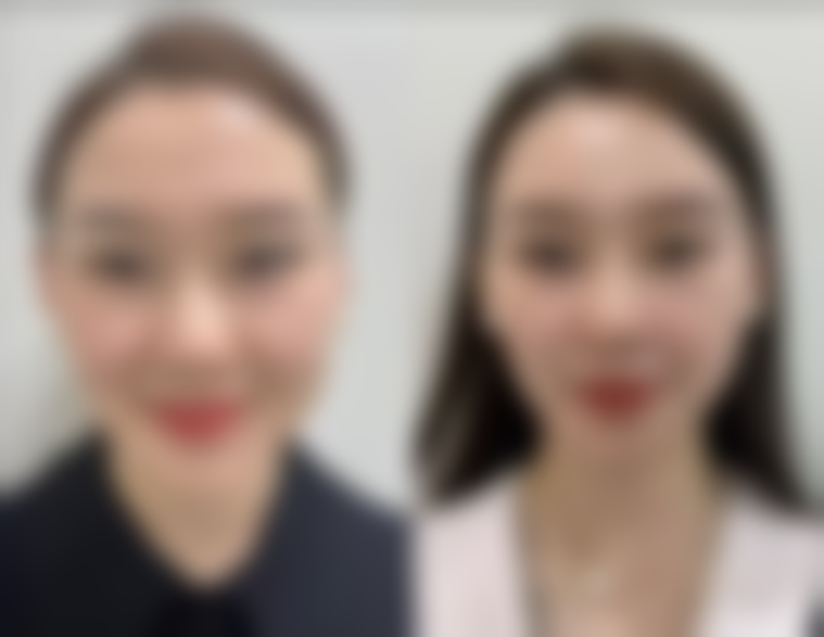 玻璃酸去眼袋的成效及维持时间