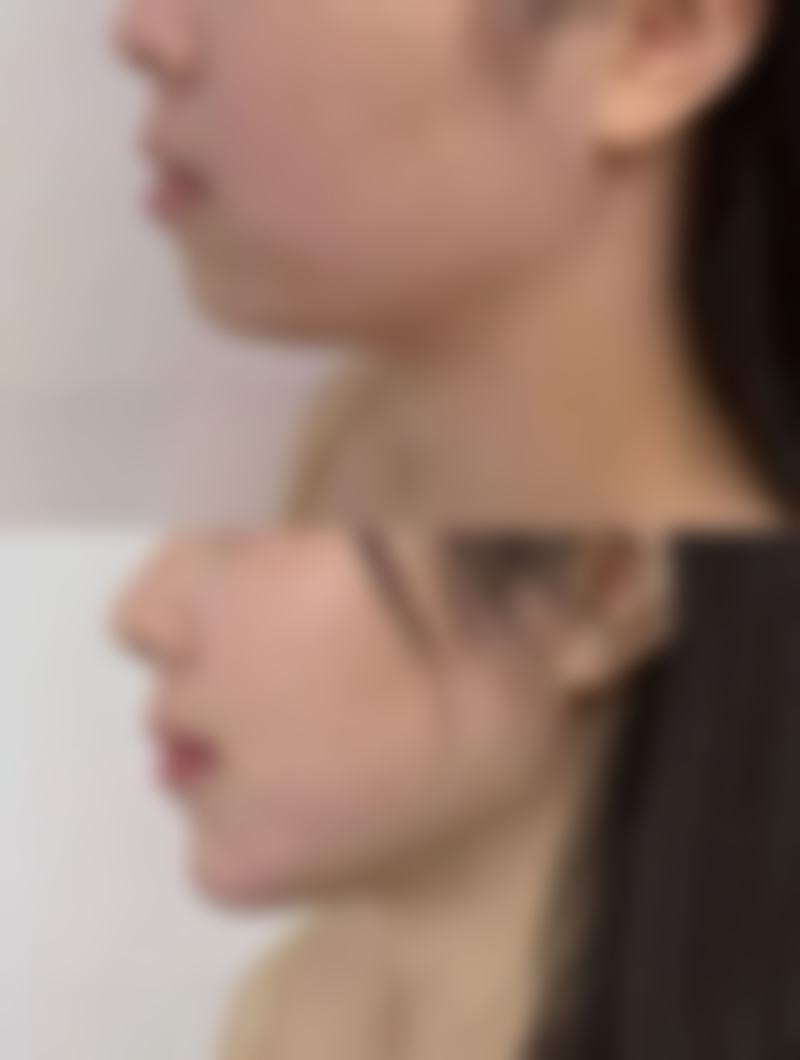 选对医院医生：隆胸安心的关键保护