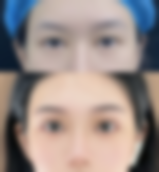 玻尿酸注射隆胸：微创便捷的时尚之选