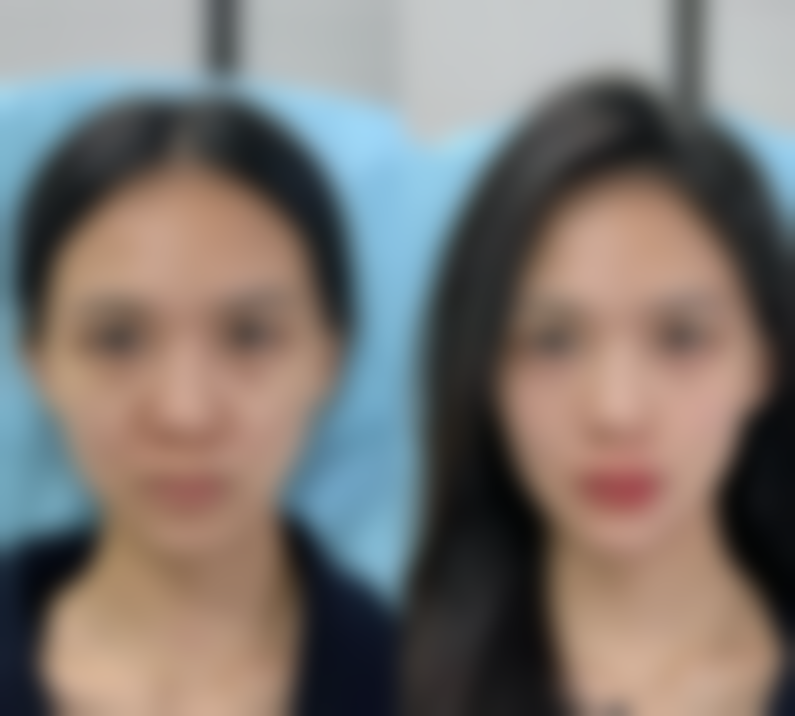 品质出色典范:德国宝俪假体深度剖析