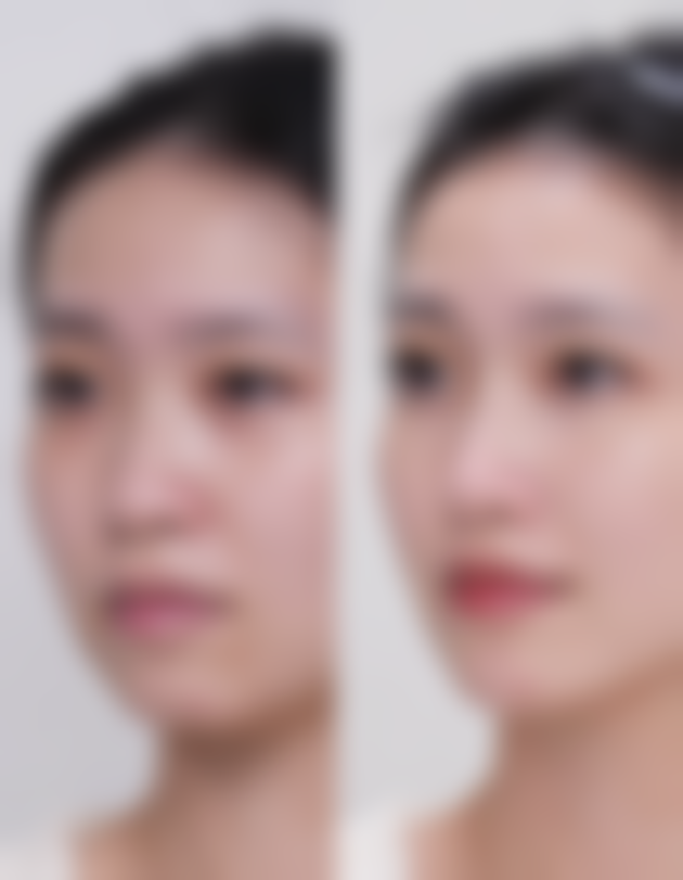 不同品牌假体隆胸：特点与选择攻略