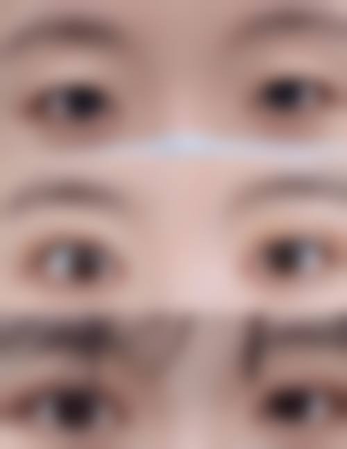 杜园园眼睛修复案例｜显微缝合+脂肪填充技术，助多位患者闭眼无痕，满意度超 90%！ 