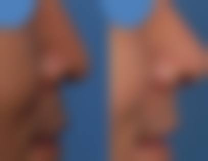 鼻整形项目：多样且定制