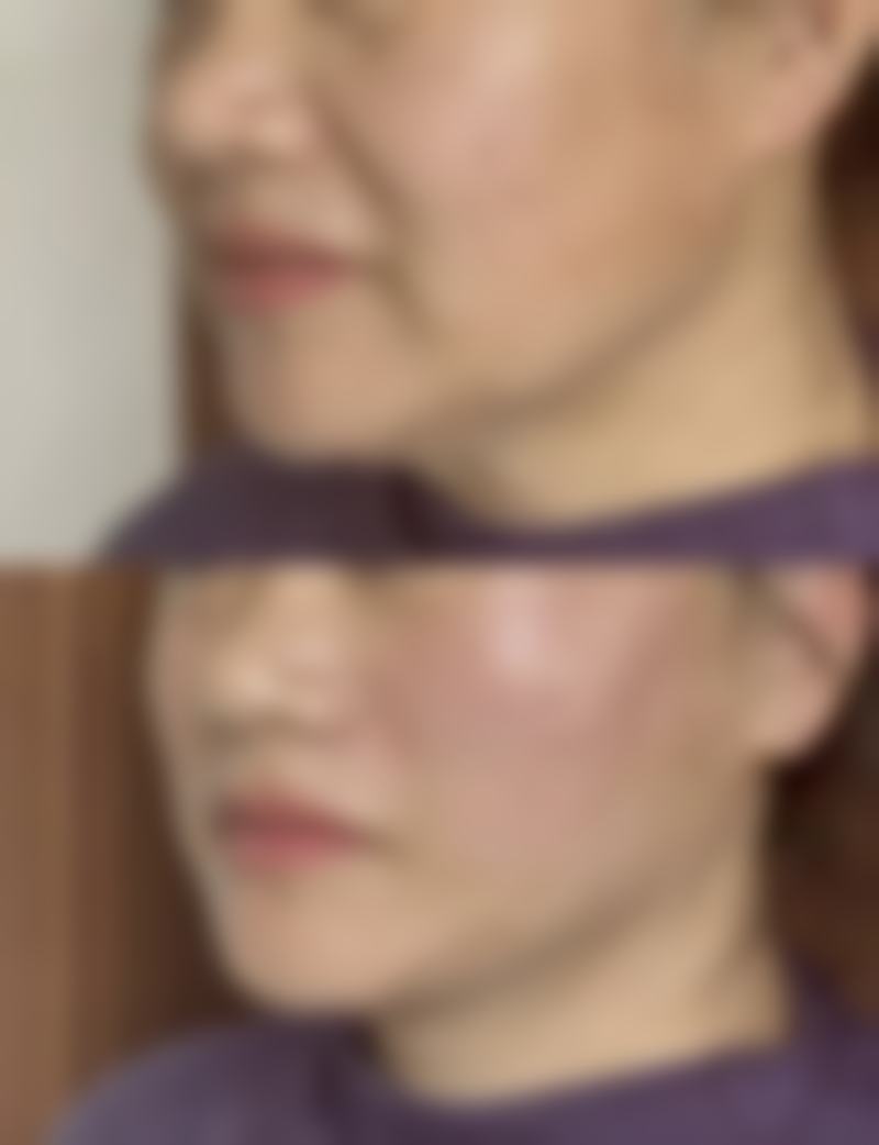 疤痕体质能做医美吗？慎选有创项目，可选激光微创或专业疤痕管理套餐