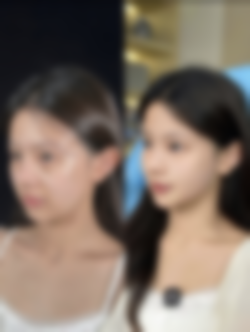 双眼皮手术方式的选择