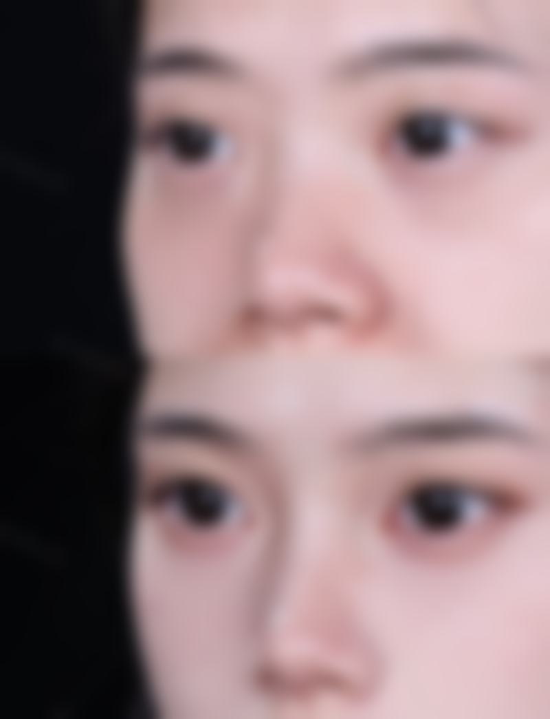 全切双眼皮15天增生怎么办？先辨轻重，轻度靠护理自愈，中重度可用药或激光干预