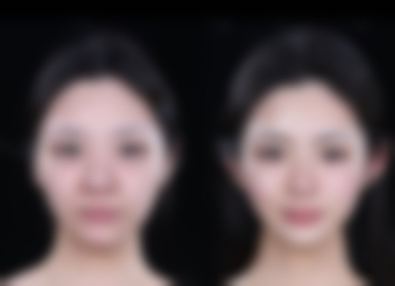 眼皮松了做双眼皮能改善吗？选全切可去皮去脂，能紧致眼周还显年轻有神