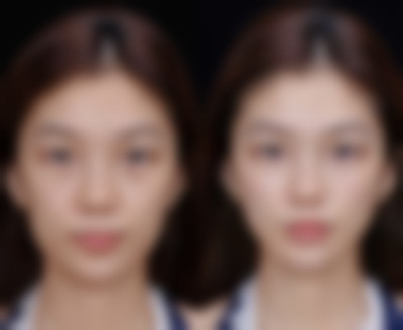 日常护理去眼袋：预防改善的基础之道