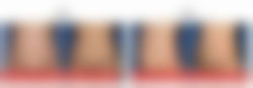 隆鼻玻尿酸能维持多长时间？宝尼达可撑5-8年，普通款依分子大小为6-24个月