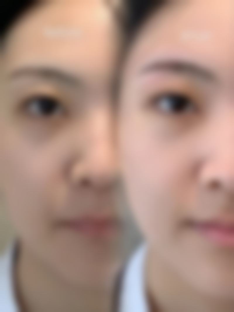 衡阳爱思特医疗美容医院怎么样啊？磨骨实例效果好收费合理，服务贴心值得选！ 