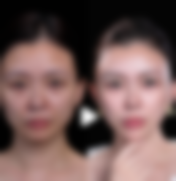 常见隆胸假体品牌的使用年限