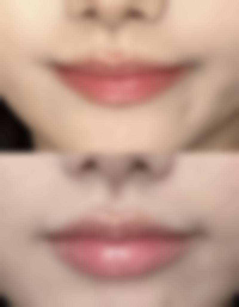 如何延长隆鼻玻尿酸的维持时间