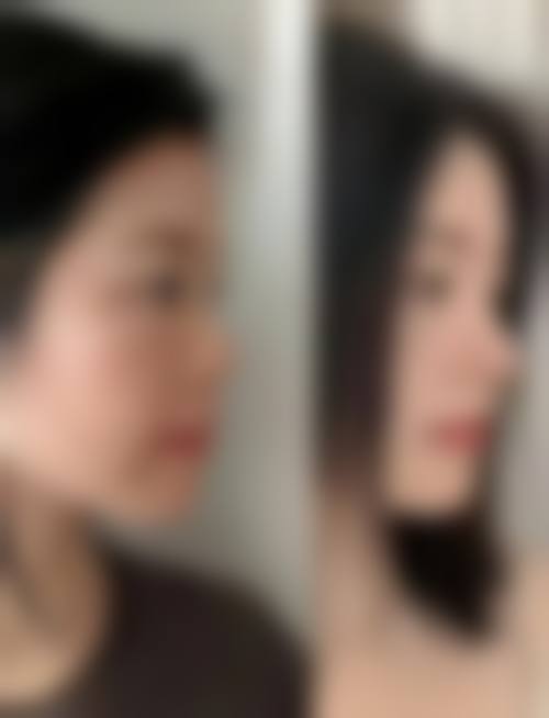 从吸脂项目看性价比