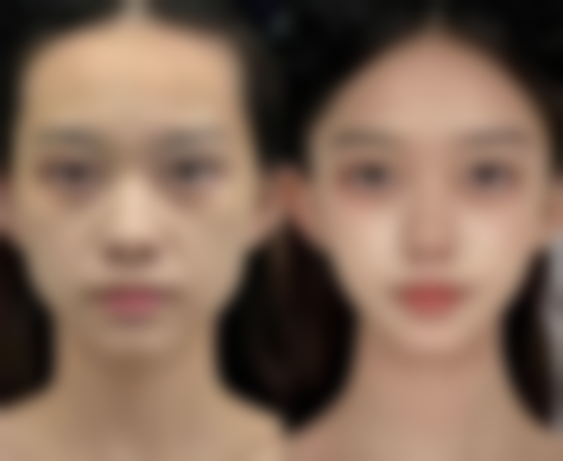 海薇大分子玻尿酸打鼻子术后30天恢复效果照片 ，展示真人案例体验，2000 - 4000元效果值得！ 