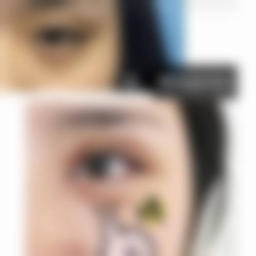 太原割双眼皮好医生