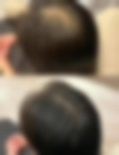 其他植发技术与项目