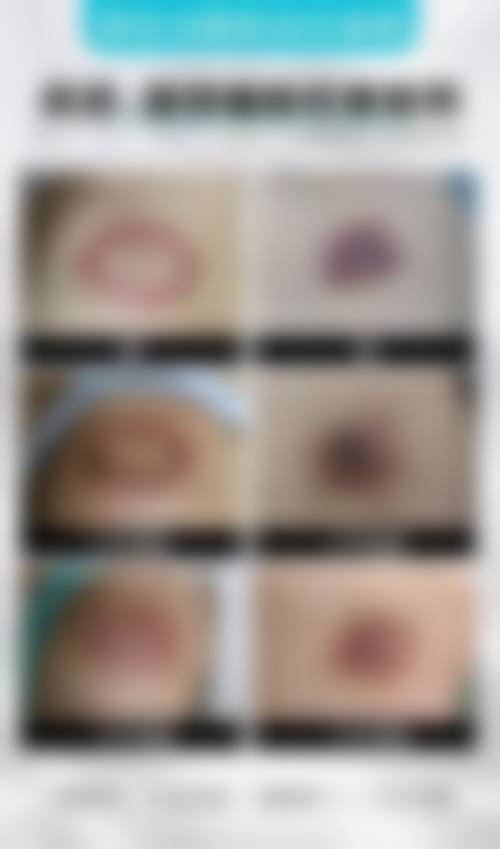 深圳祛疤可靠正规医院名单前十：鹏程、美莱等上榜，技术多元服务优口碑好！ 