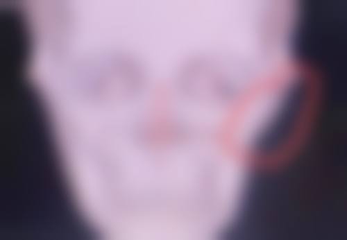 冰敷眼睛能消眼袋吗？仅能缓解眼部水肿，脂肪型眼袋需专业祛眼袋手术