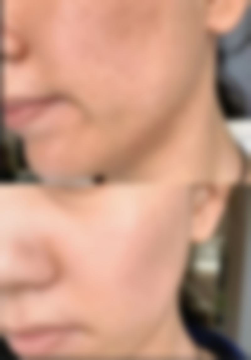 术后护理，保护植发成效的关键