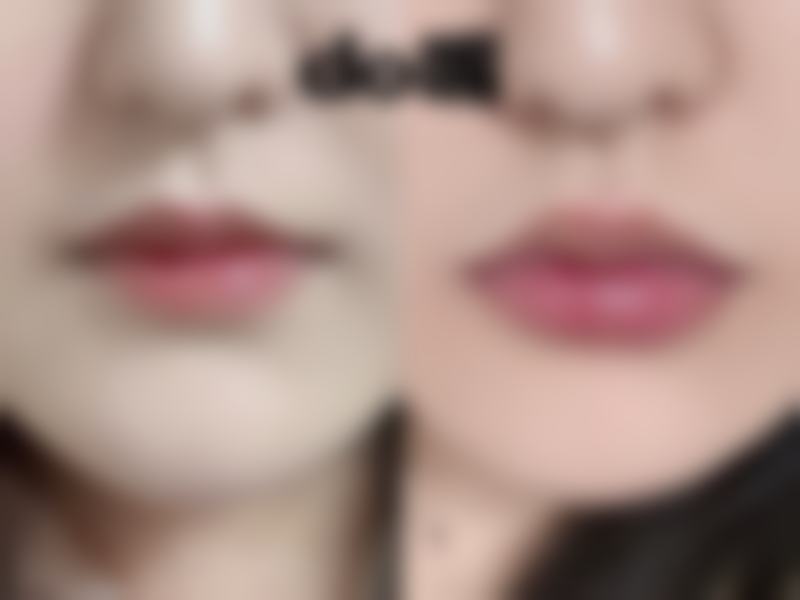 割双眼皮以后会不会下垂？多为自然衰老造成的，选正规医生、做好护理可延缓，也能修复