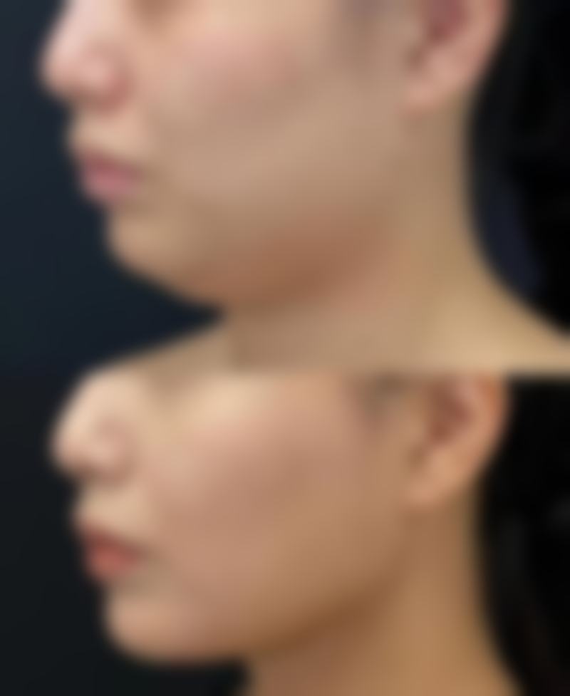 常见颧骨整形手术大盘点