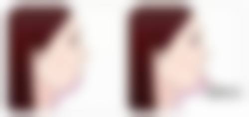 如何降低隆胸假体破裂的风险