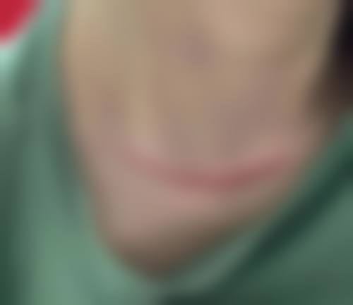 环钻去疤治疗成效