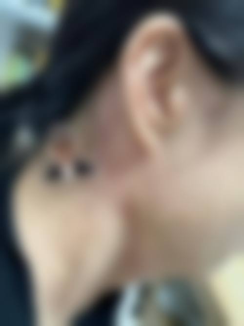 环钻去疤修复时间